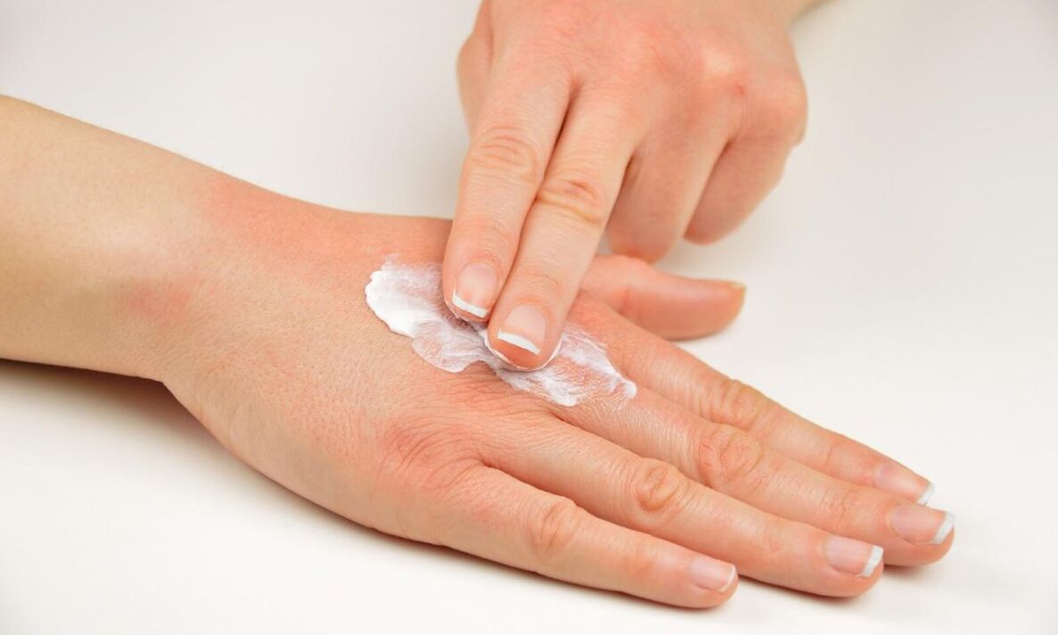 Psoriasis treatment with Keramin cream