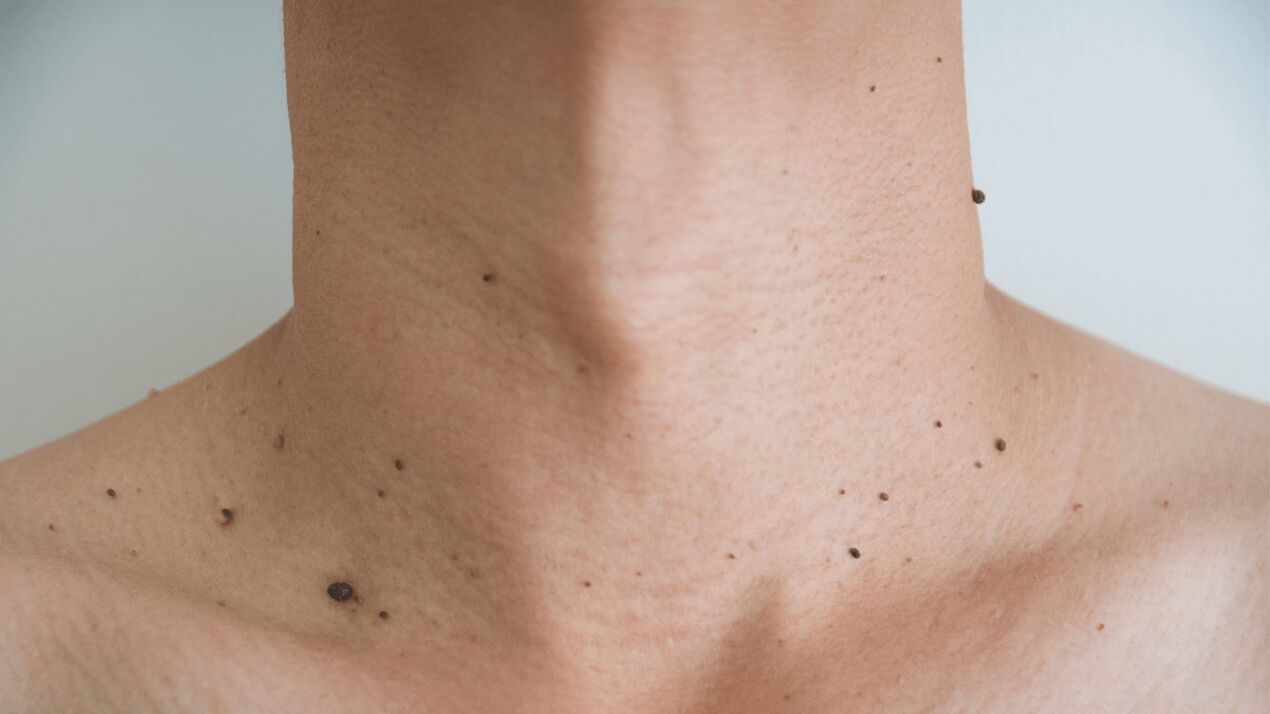 Treatment with Keramin cream for papillomas on the neck and chest