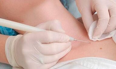 Papilloma distance methods on the neck