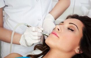 Laser wart removal