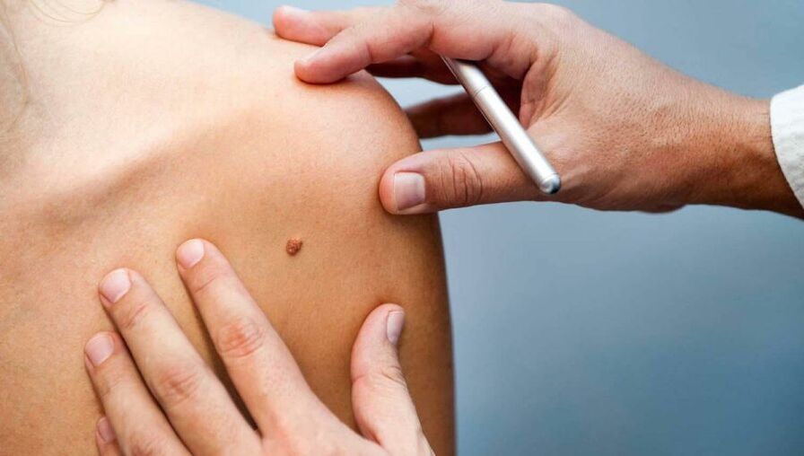 Dermatologist examines a patient with papilloma