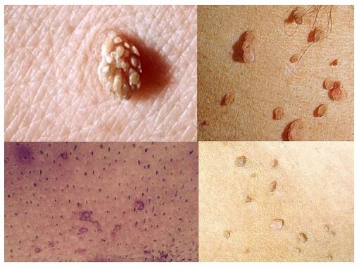 Genital warts on the body