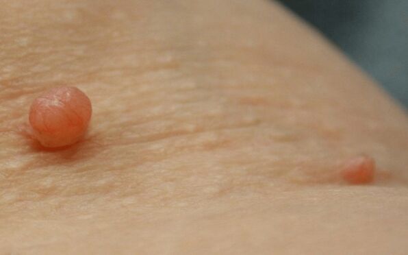 Papilloma on the body