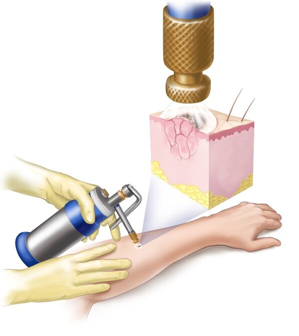 Removal of papillomas with liquid nitrogen