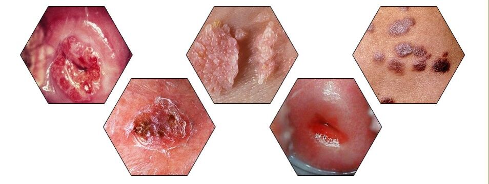 Types of dangerous papillomas