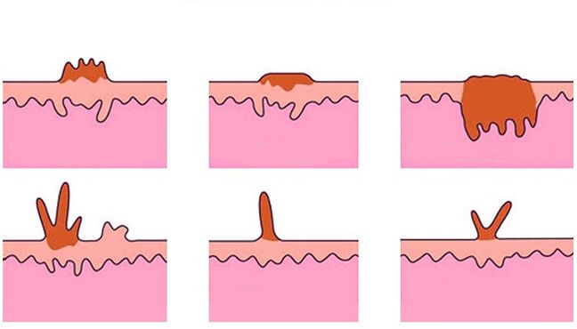 Types of papillomas on the body