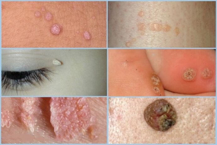 Types of papillomas on the face and body