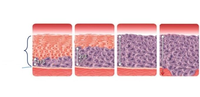 cervical dysplasia