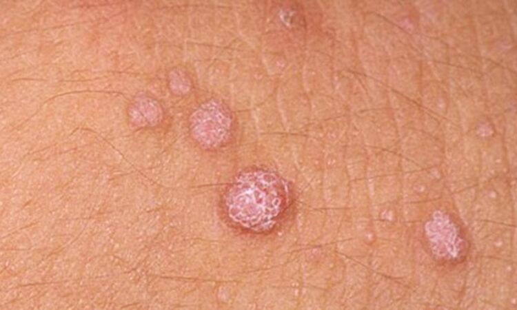 HPV leads to the appearance of skin papillomas