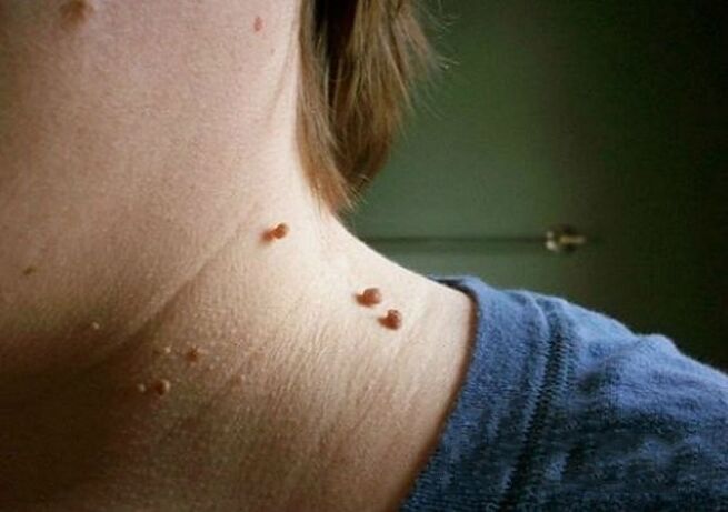 Papillomas on the neck