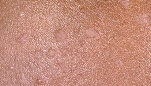 Flat condylomas on human skin
