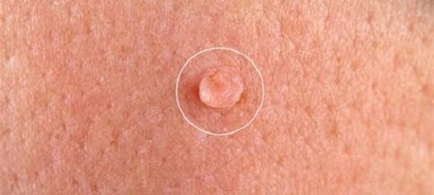 Genital warts on the body