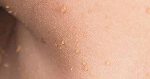How does the human papillomavirus manifest itself
