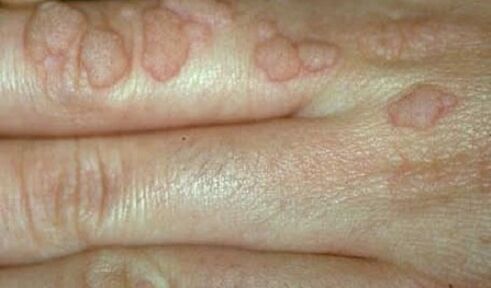 Human papilloma virus on hands