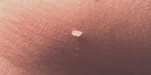 Human papillomavirus on the skin