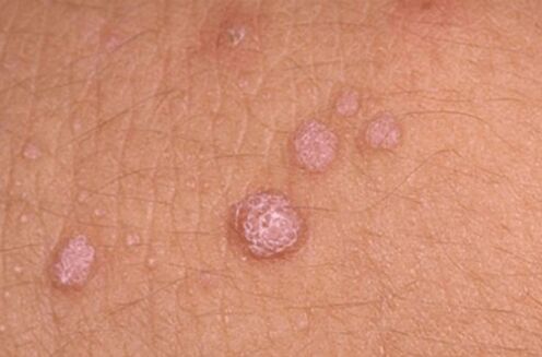 Symptoms of human papillomavirus