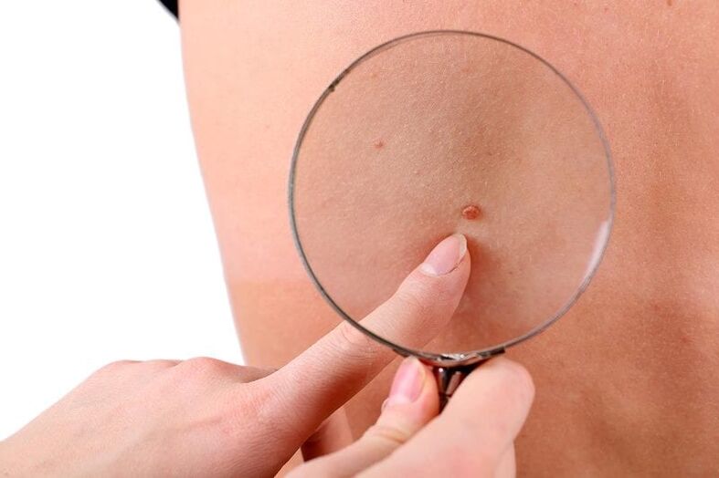 Papilloma under the magnifying glass
