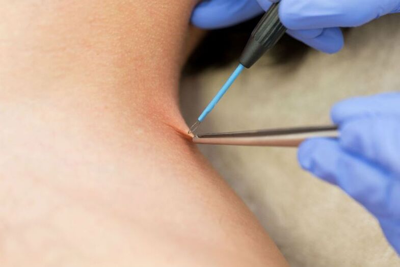 The procedure for removing papillomas using electrocoagulation