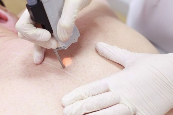 A popular method of removing papillomas using a laser