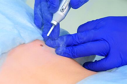 Laser papilloma removal