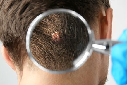 papillomas on the head