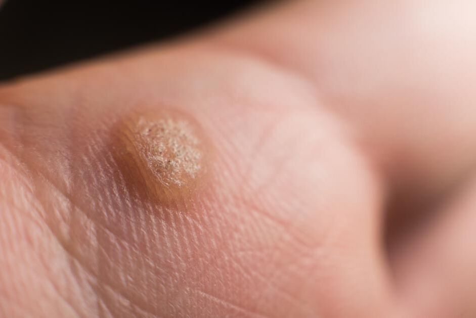 Human papillomavirus on the skin