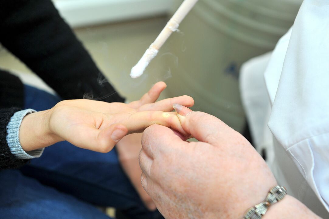 Recovery period after wart removal