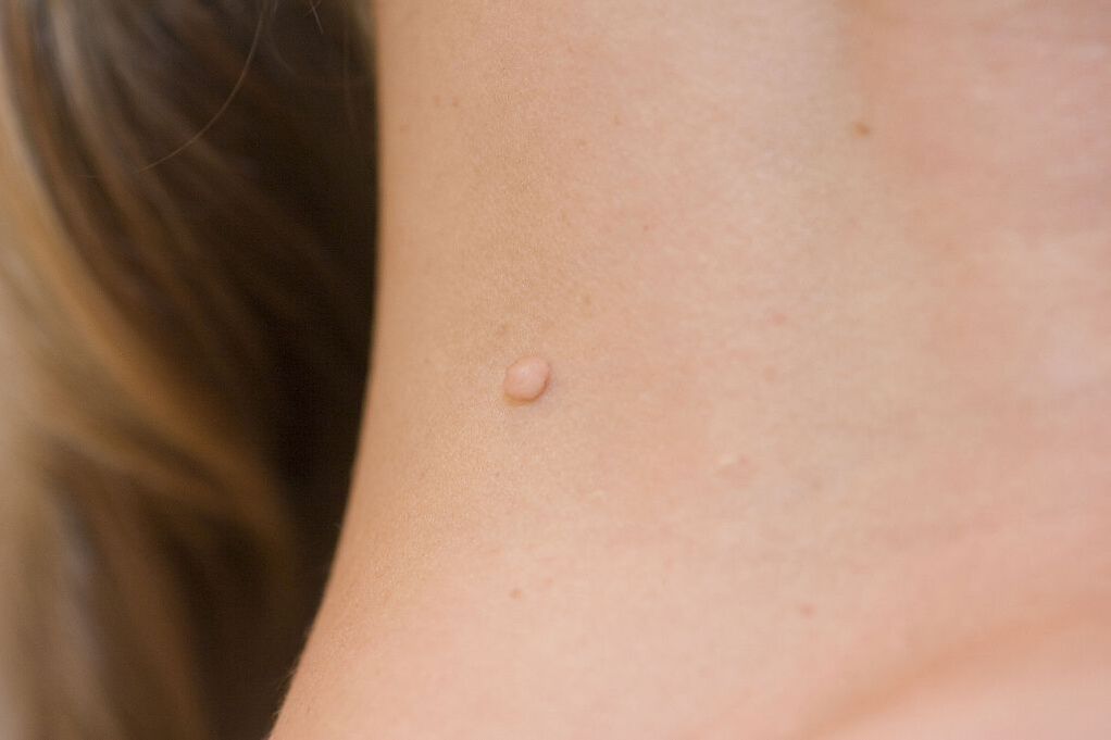 HPV symptoms