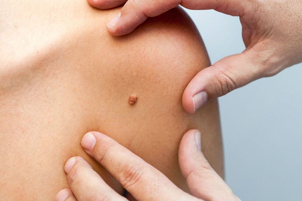 Papillomas on the human body