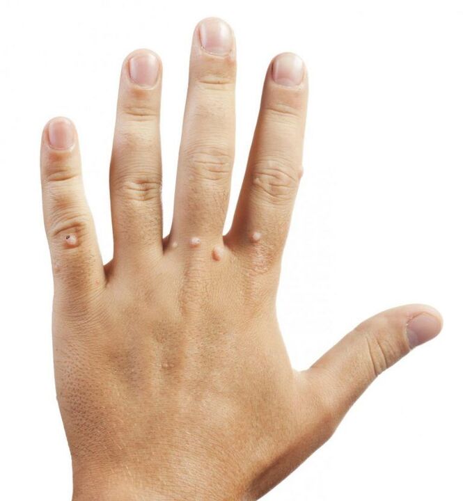 Warts on the hands