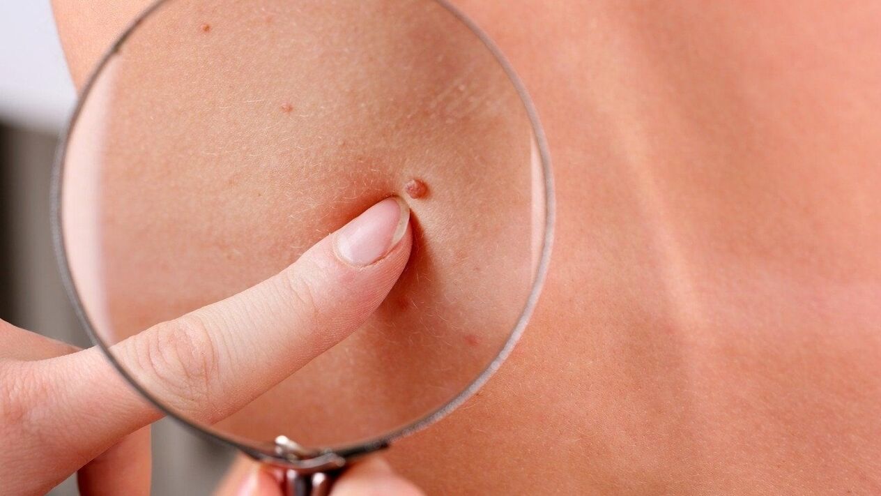 Papillomas in the armpit area