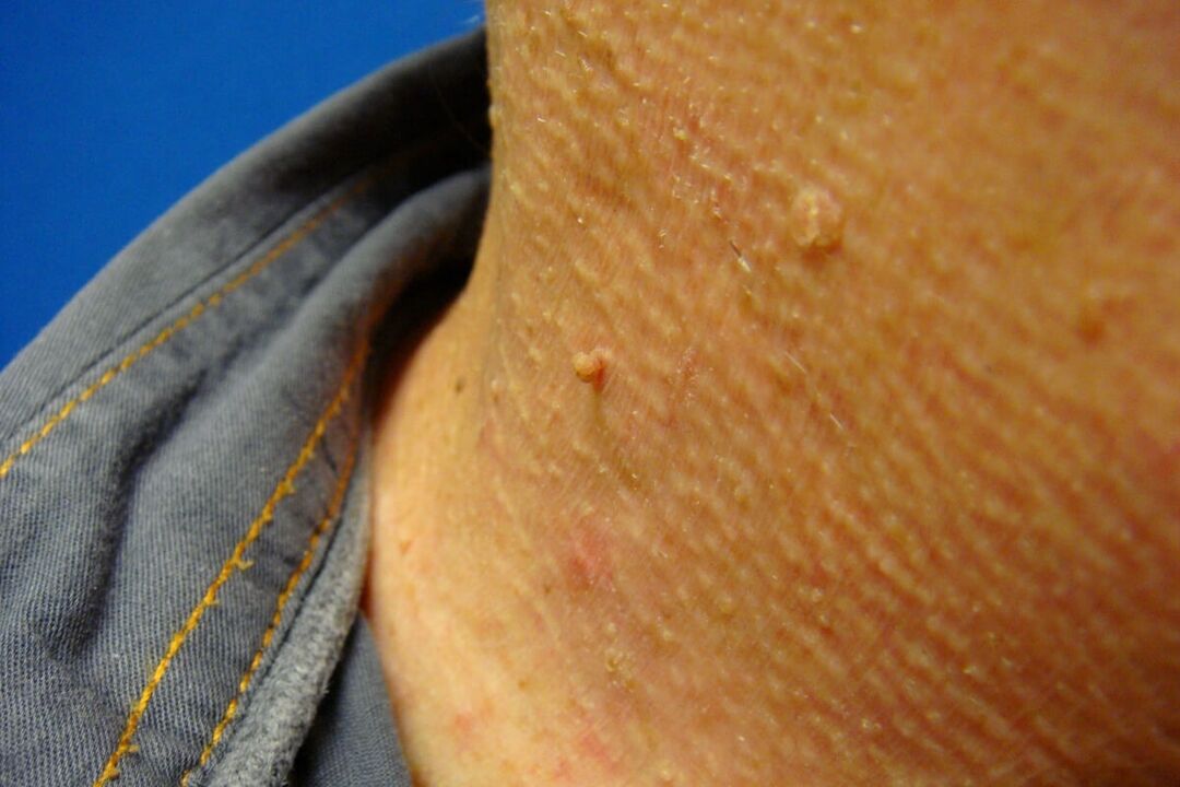 Papillomas on the human neck