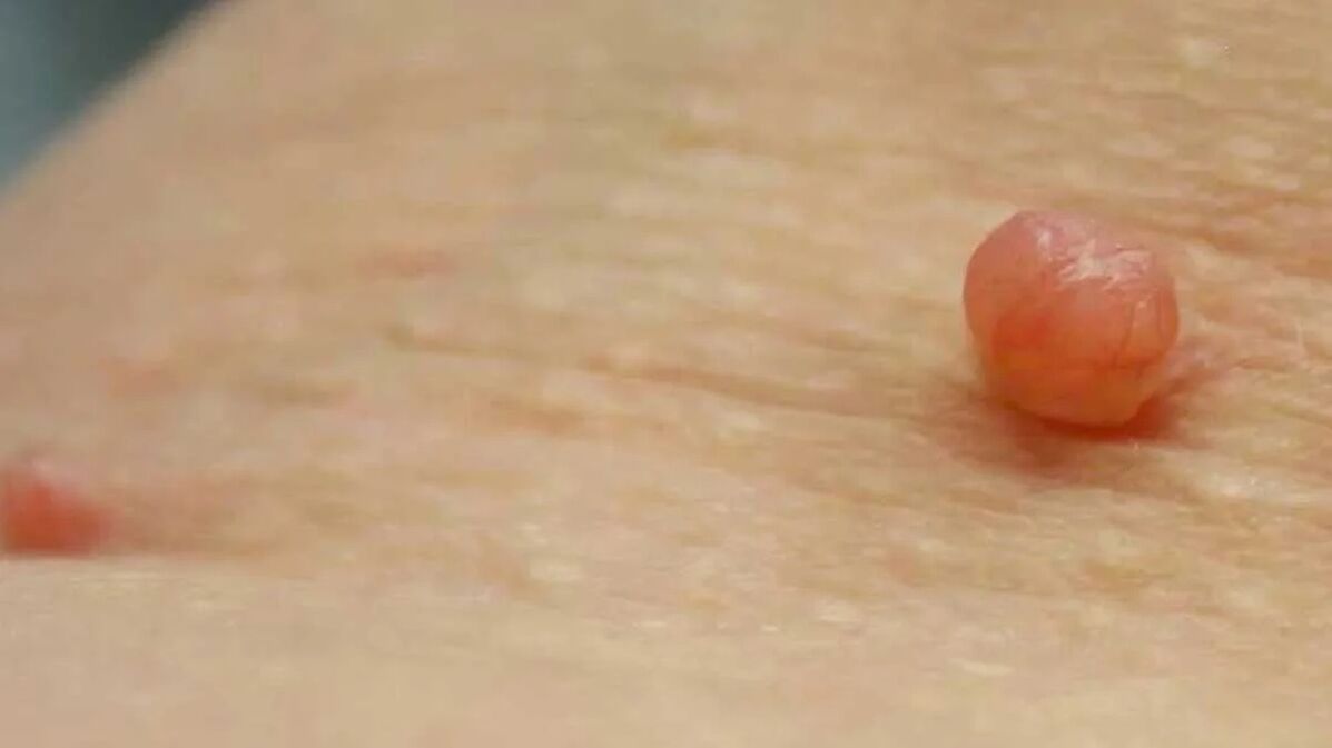 Removal of papillomas at home