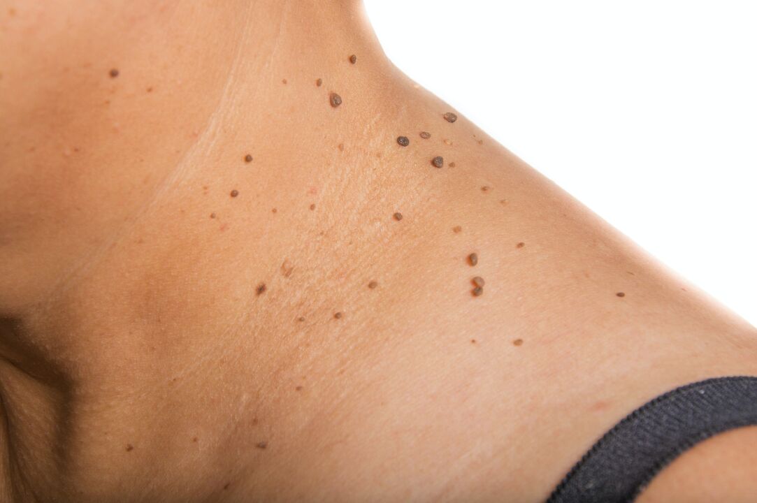 an isolated papilloma on the neck
